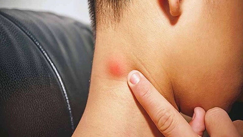 Nguyên nhân nổi hạch sau gáy - Sưng hạch sau gáy có nguy hiểm không? 2