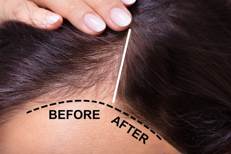 Tìm hiểu chi tiết về nguyên nhân rụng tóc do bệnh lý và thuốc 4