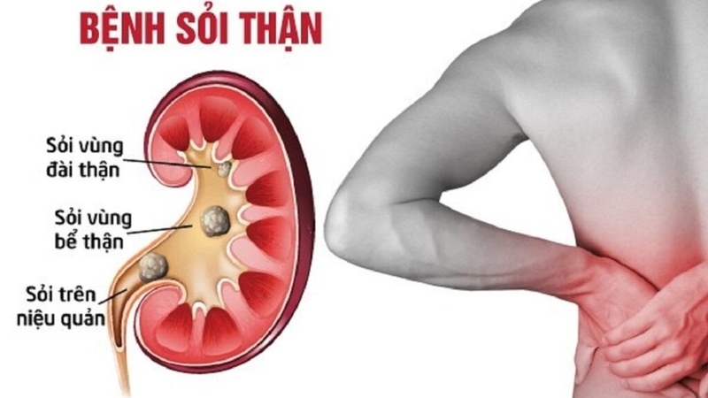 Nguyên nhân sỏi thận: Quá trình hình thành sỏi thận