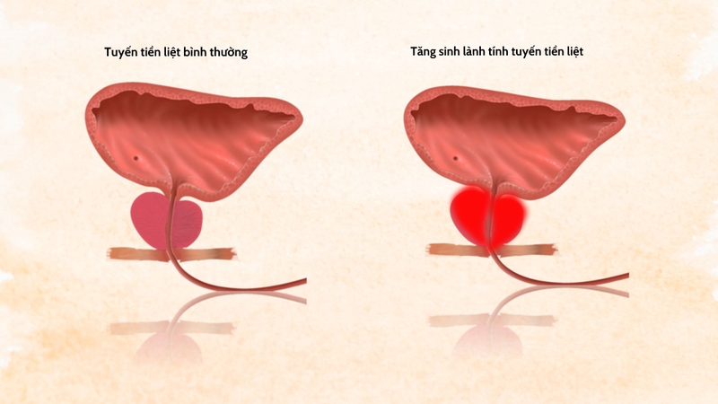 Nguyên nhân tăng sinh lành tính tuyến tiền liệt và cách điều trị1