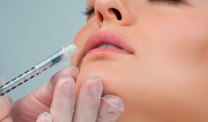 Nguyên nhân tiêm filler môi 2 tháng bị sưng? Có cách khắc phục không? 2