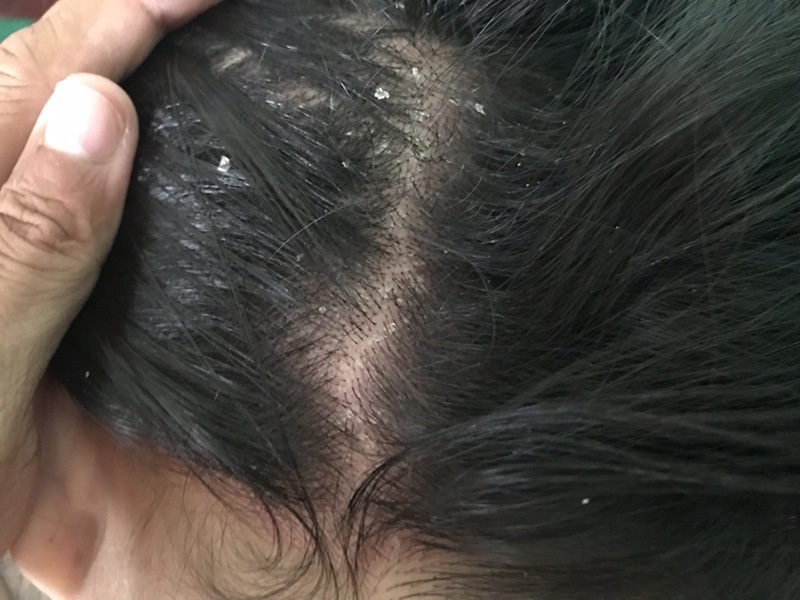 Nguyên nhân tóc bị gàu mảng và cách phòng ngừa hiệu quả