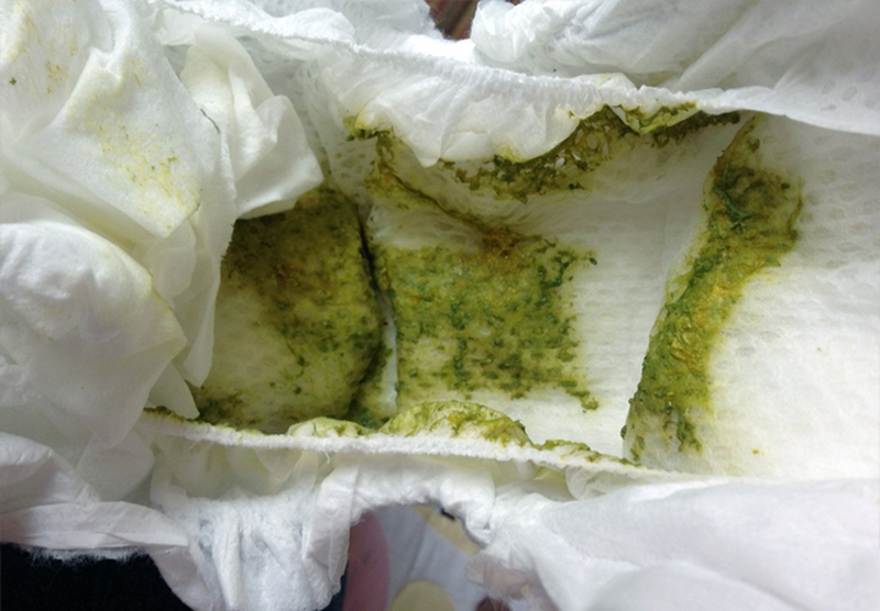 Trẻ sơ sinh đi phân xanh 2