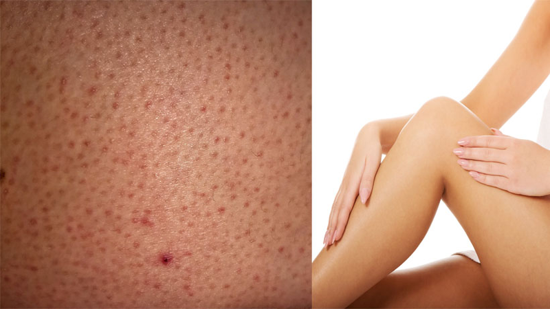 Nguyên nhân triệt lông xong bị viêm lỗ chân lông và cách điều trị 1