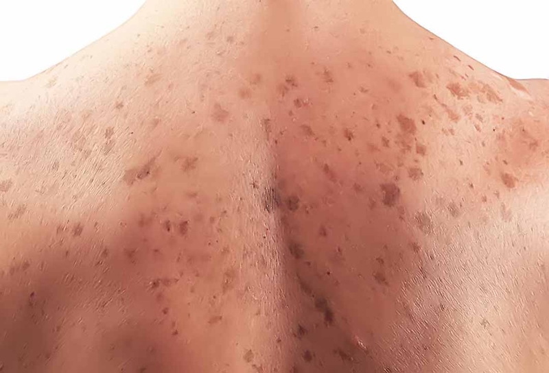 Ung thư da hắc tố là một bệnh da liễu nguy hiểm, thường ảnh hưởng đến những người ở độ tuổi dưới 40, đặc biệt là phụ nữ