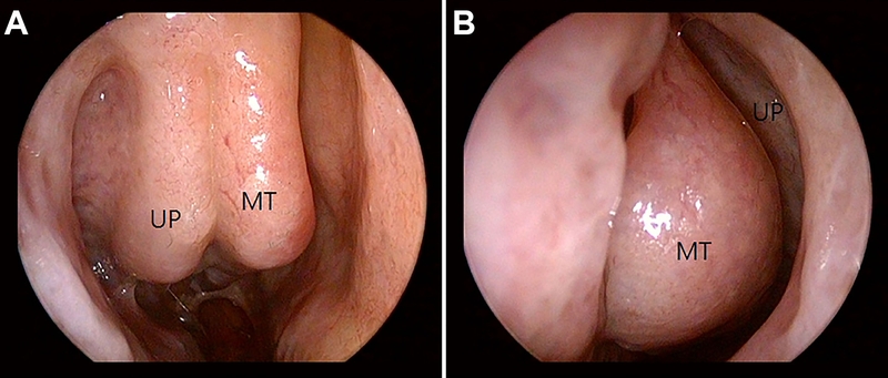 Nguyên nhân, triệu chứng và cách điều trị phì đại cuốn mũi2
