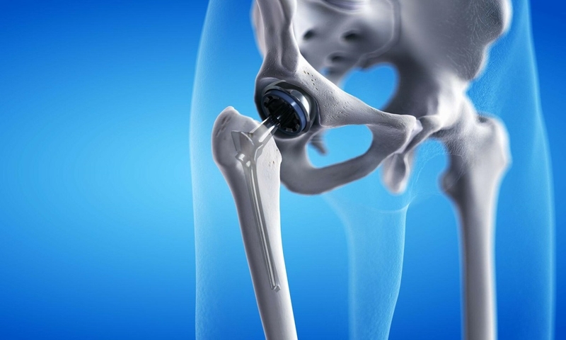 Nguyên nhân, triệu chứng, cách điều trị viêm khớp háng nhiễm khuẩn2