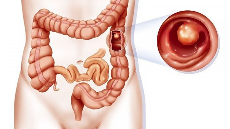 Nguyên nhân, triệu chứng, chẩn đoán và các phương pháp điều trị hội chứng Lynch 3