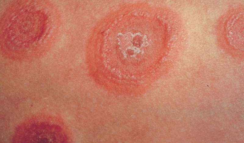 Nguyên nhân, triệu chứng của hắc lào sinh dục và bài thuốc chữa trị dân gian 1