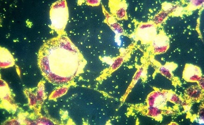 Nguyên nhân, triệu chứng, hình ảnh về bệnh đau mắt hột 1