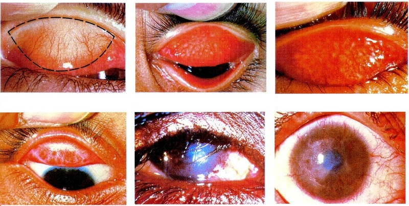 Nguyên nhân, triệu chứng, hình ảnh về bệnh đau mắt hột 3