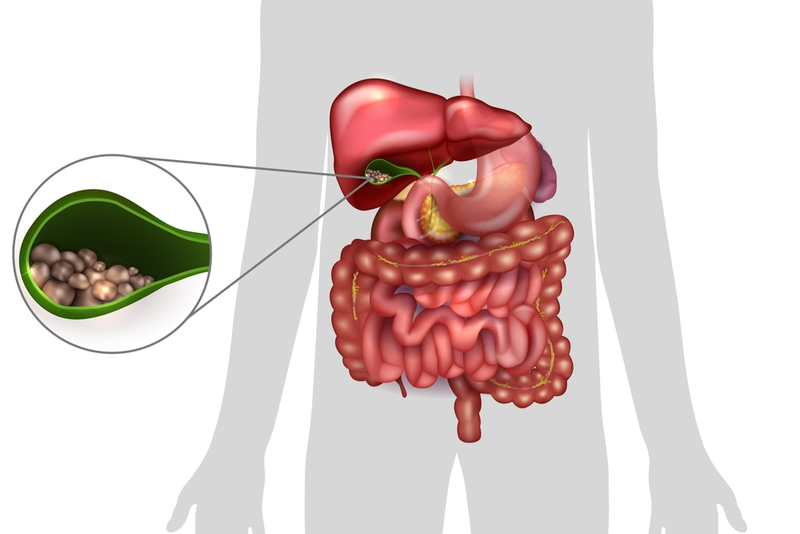Nguyên nhân, triệu chứng và cách điều trị sỏi túi mật 11mm-3