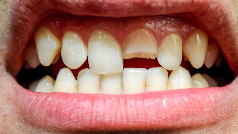 Nguyên nhân tủy răng bị thối và cách khắc phục 1