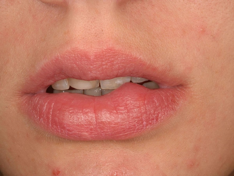 Nguyên nhân u nang nhầy ở môi và cách điều trị 1