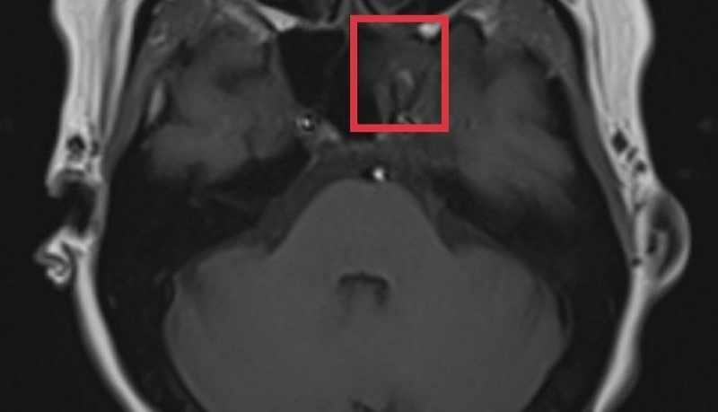 Nguyên nhân u nang nhầy ở môi và cách điều trị 2