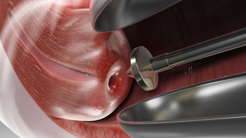 Nguyên nhân u nang nhầy ở môi và cách điều trị 3