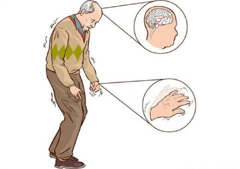 Nguyên nhân và biểu hiện của hội chứng Parkinson thứ phát và không điển hình 2
