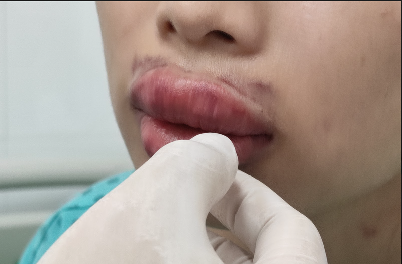 Filler không đảm bảo chất lượng là nguyên nhân gây môi sưng khi tiêm filler