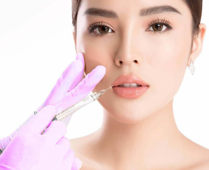 Filler không đạt chất lượng là nguyên nhân làm cho môi bị bầm tím sau khi tiêm