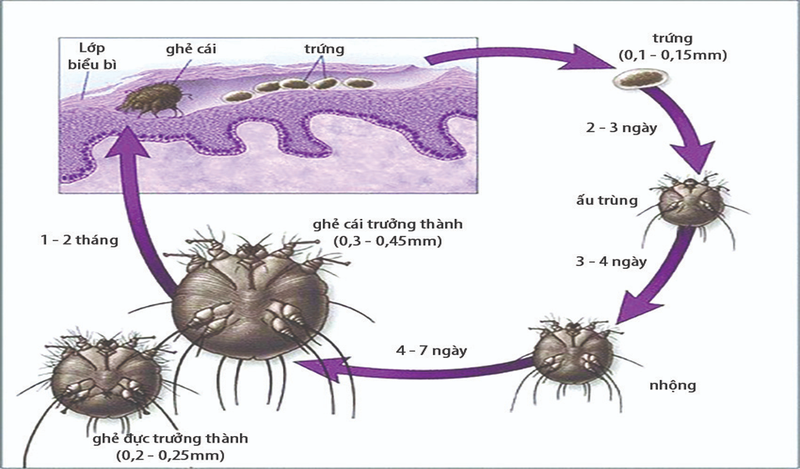 Triệu chứng của bệnh ghẻ ở bộ phận sinh dục nam có thể bị nhầm với bệnh hạ cam