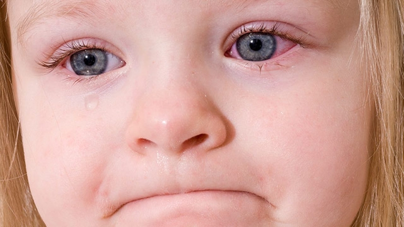 Trẻ cần được giữ vệ sinh sạch sẽ để ngăn ngừa viêm kết mạc dị ứng