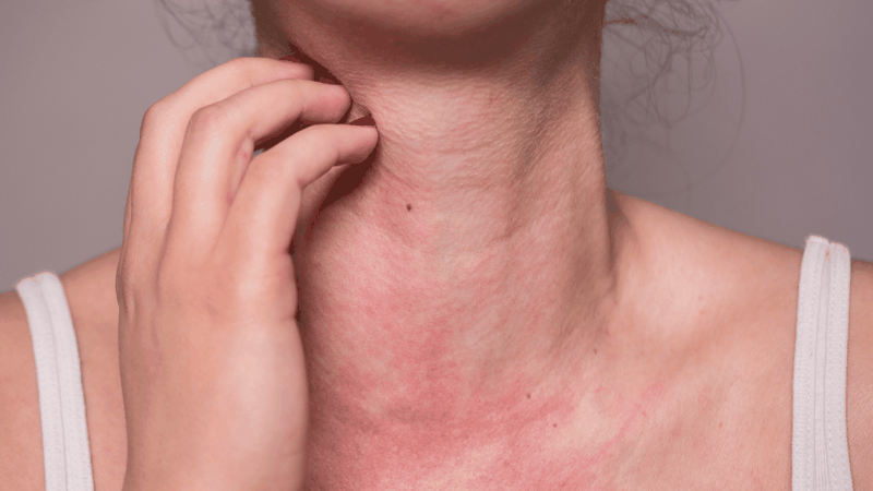 Mẹ bầu có làn da nhạy cảm, dễ bị đỏ và mẩn ngứa khi tiếp xúc với mùi hương nhân tạo như nước hoa hoặc sản phẩm tạo mùi trong không gian kín