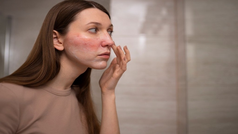Nguyên nhân và cách phòng tránh căn bệnh rosacea 1