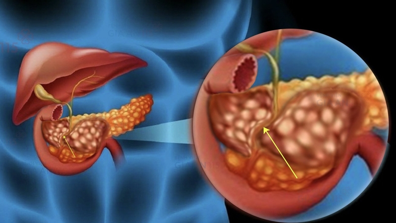 Tắc ống mật có nguy hiểm không? Nguyên nhân và cách phòng tránh3