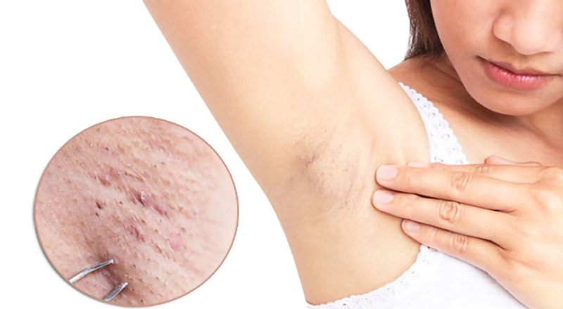 Bạn cần lưu ý không được tự ý nặn mụn để tránh làm viêm nhiễm vùng da bị mụn và vùng da xung quanh