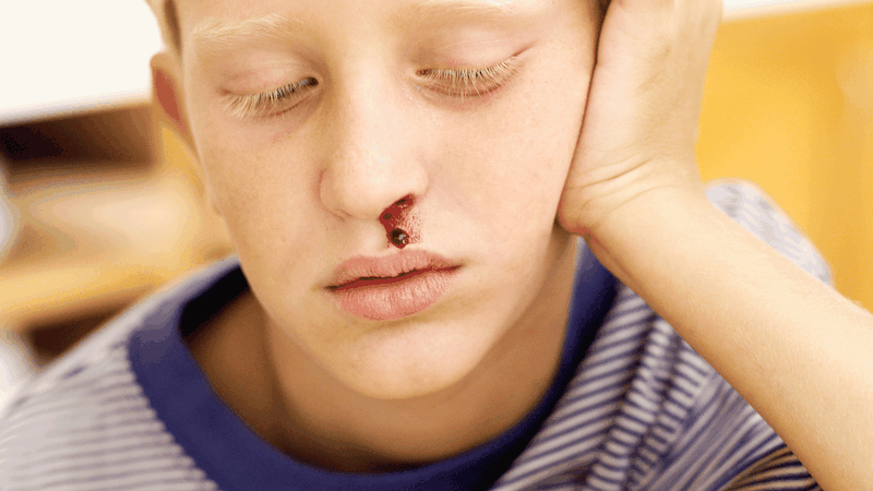 Chảy máu mũi 1 bên trái do thời tiết hanh khô, khó chịu