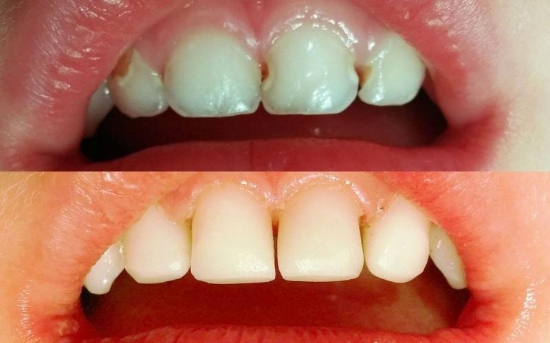 Nguyên nhân và dấu hiệu bạn bị sâu răng cửa