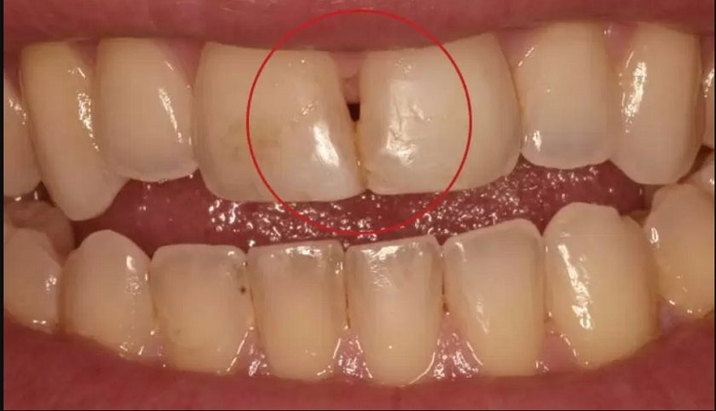 Nguyên nhân và dấu hiệu bạn bị sâu răng cửa