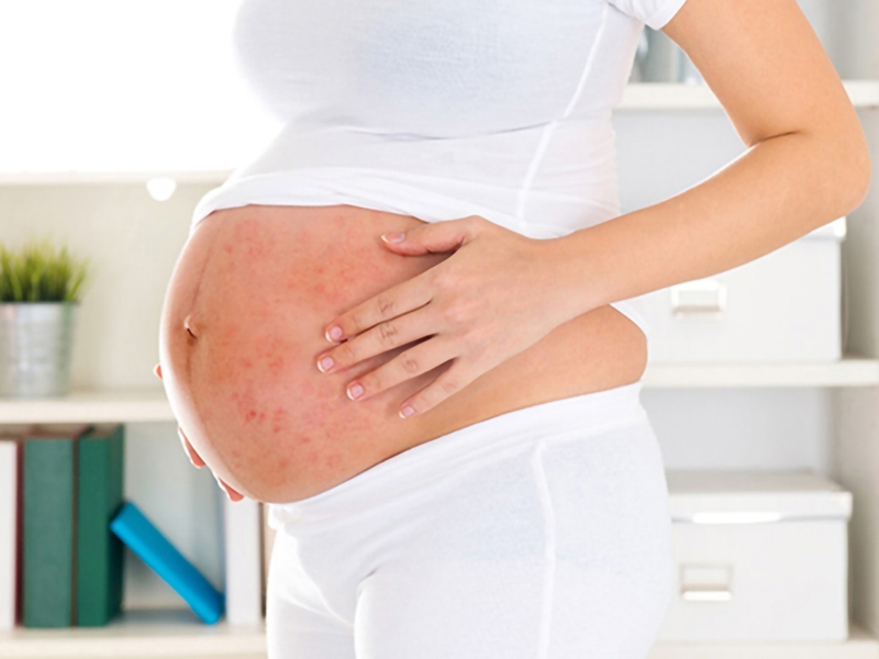 Nổi mề đay, mẩn ngứa là một số bệnh ngoài da thường gặp ở phụ nữ mang thai