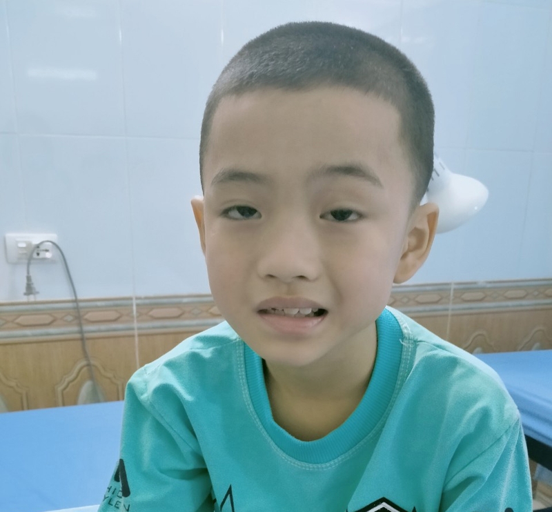 Nguyên nhân gây liệt dây thần kinh số 7 ở trẻ em.