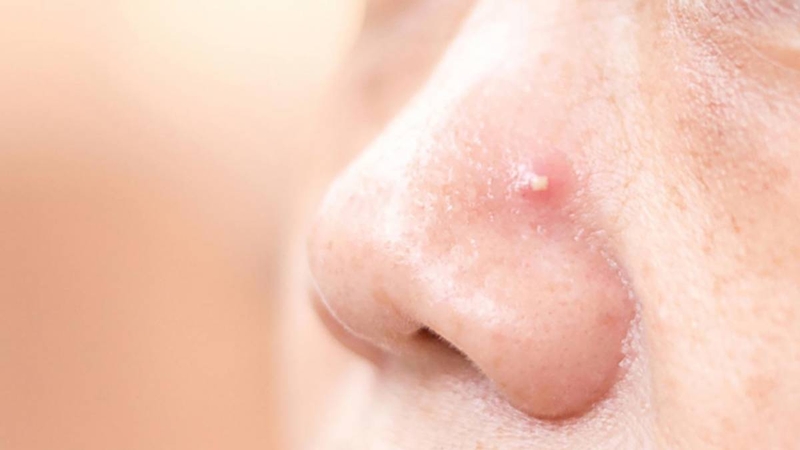 Nguyên nhân và dấu hiệu bị mưng mủ sau khi nâng mũi là gì? 1