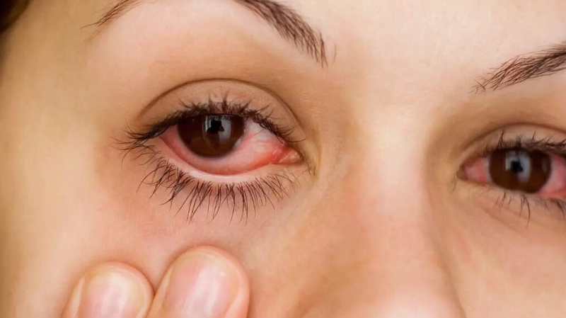 3 nguyên nhân chính gây viêm kết mạc có thể bạn chưa biết 3