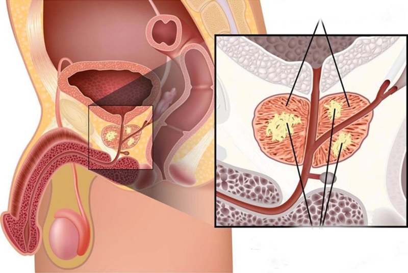 Nguyên nhân vôi hóa tuyến tiền liệt và những điều nên biết&nbsp;1
