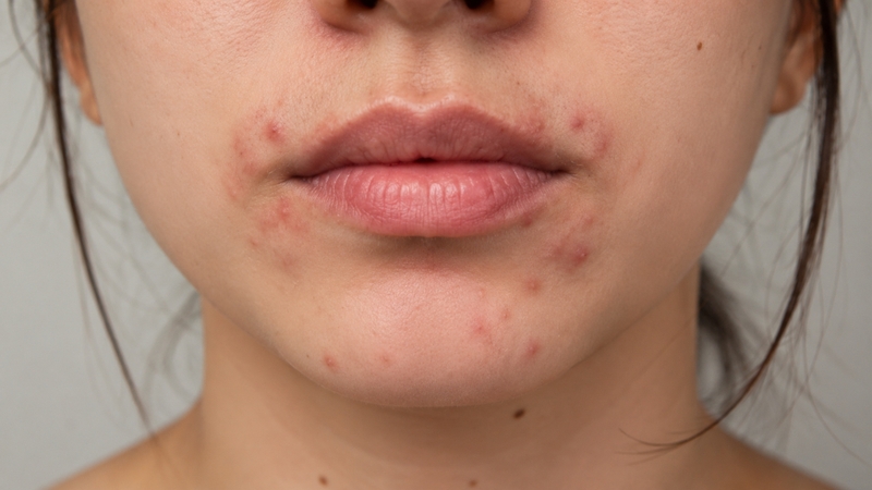 Sự biến động hormone là một trong những nguyên nhân phổ biến gây mụn quanh miệng