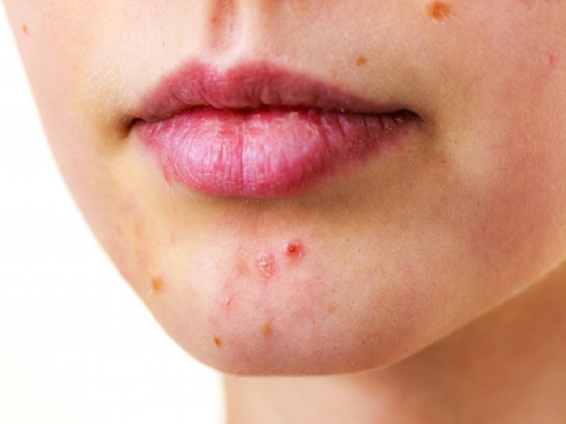 Nguyên nhân xuất hiện mụn quanh miệng và cách điều trị-1