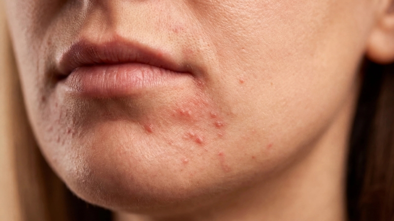 Stress có thể làm tăng nguy cơ xuất hiện mụn quanh miệng