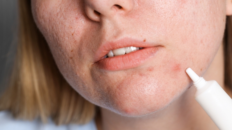 Một số hoạt chất trị mụn có thể hỗ trợ làm thông thoáng lỗ chân lông