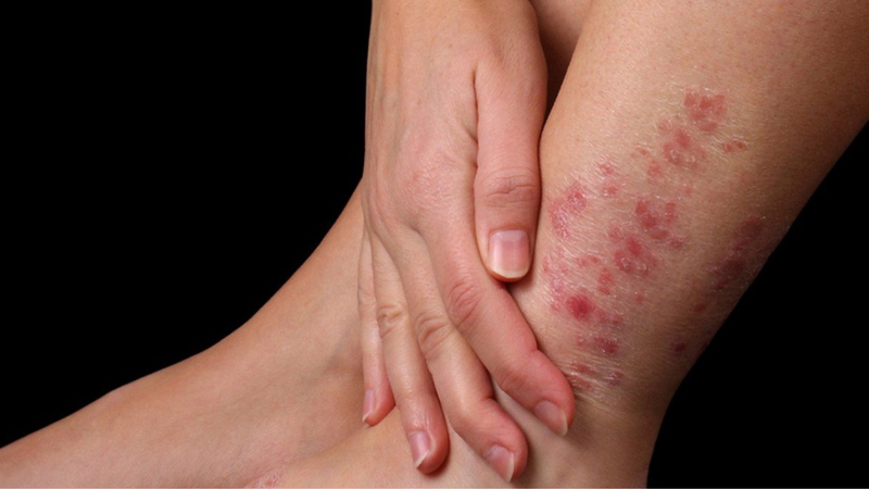 9 nguyên tắc vàng khi sử dụng Corticoid bạn cần phải biết! 2