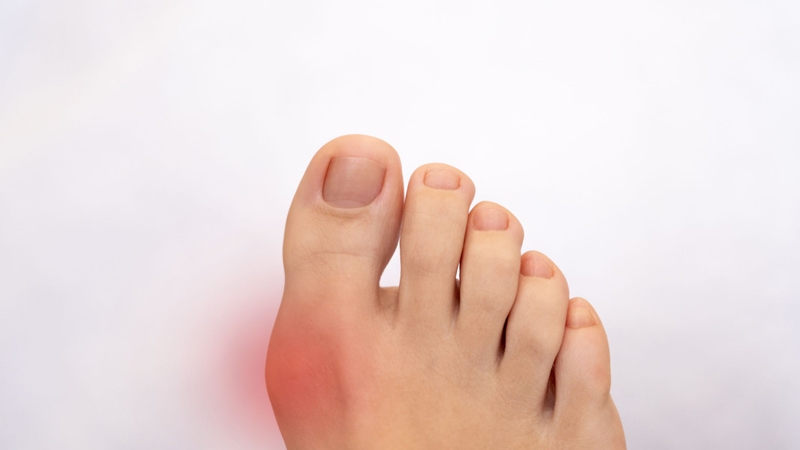 Nguyên tắc chế độ ăn dự phòng bệnh gout