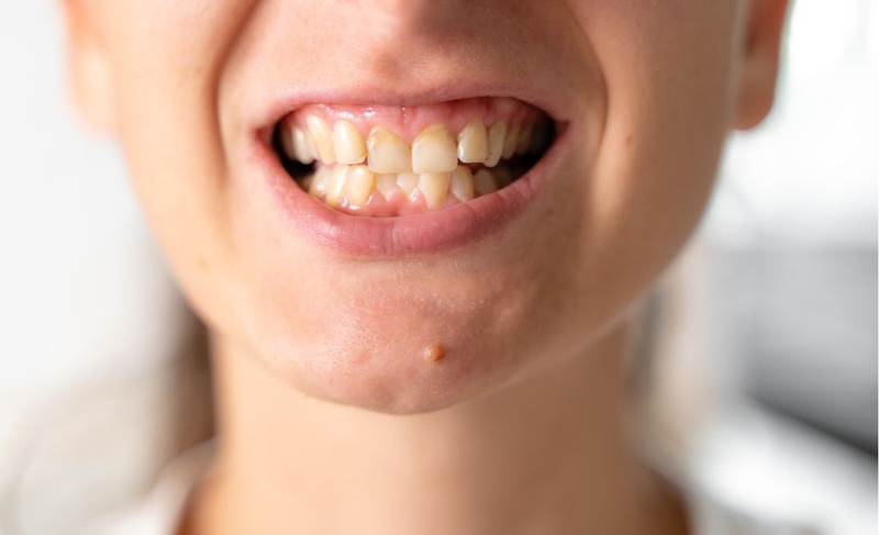 Nhai nhiều 1 bên thì bên nào to hơn​? Khắc phục thói quen nhai 1 bên 3