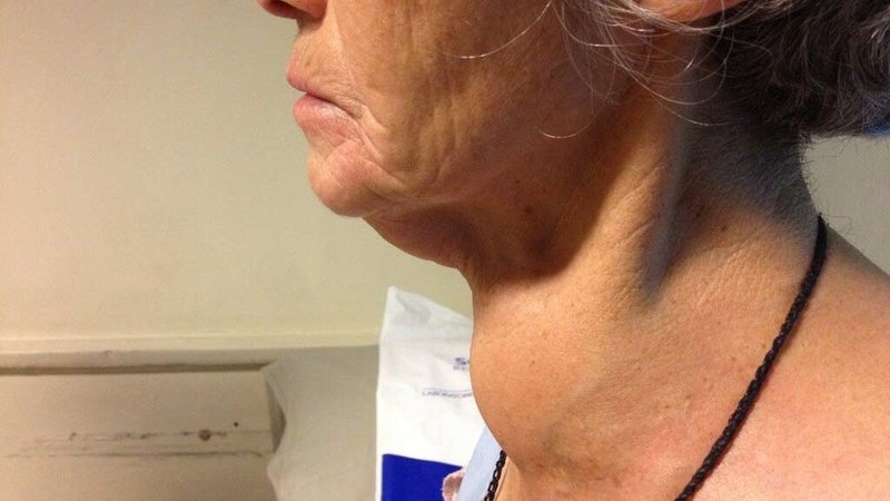Nhận biết bệnh thông qua hình ảnh bướu cổ đơn thuần 2