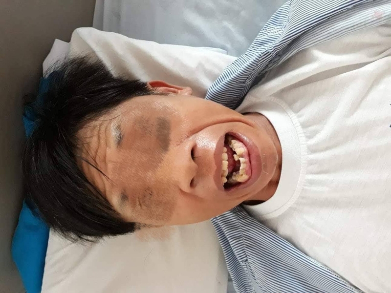 Nhận biết bệnh uốn ván và cách điều trị bệnh hiệu quả 2