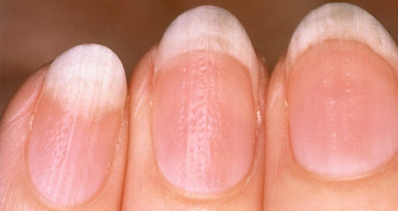 Nhận biết bệnh vảy nến nhanh nhất với ba dấu hiệu sau