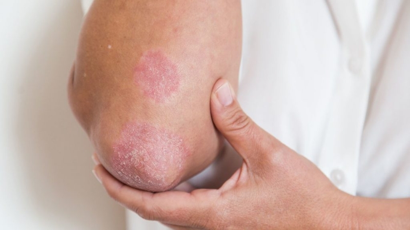 Nhận biết bệnh vảy nến nhanh nhất với ba dấu hiệu sau