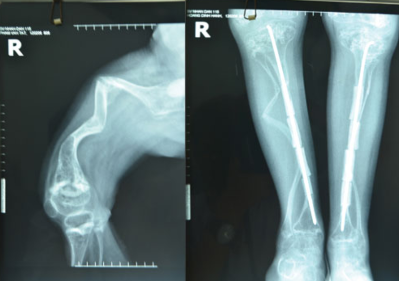 Nhận biết bệnh xương thủy tinh ở trẻ 2