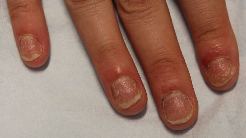 Nhận biết dấu hiệu sớm của viêm khớp vảy nến 1